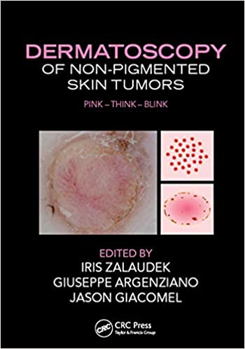 Dermatoscopy of Non-Pigmented Skin Tumors – eBook PDF